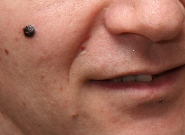 Mole excision